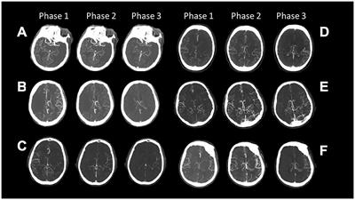 Determinants of cerebral collateral circulation in acute ischemic stroke due to large vessel occlusion